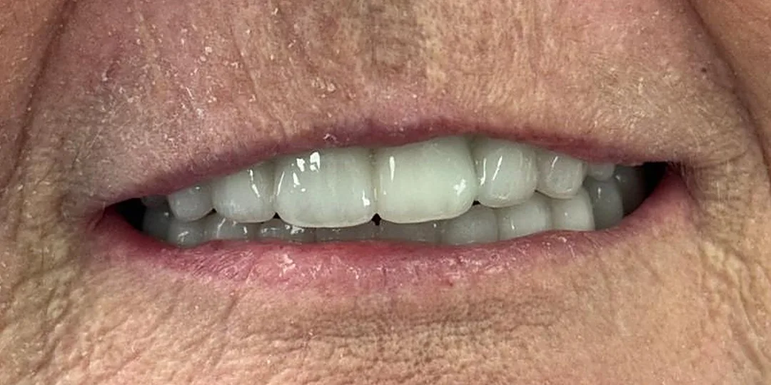 After treatment, cropped to the mouth: the final bridge, upper and lower.