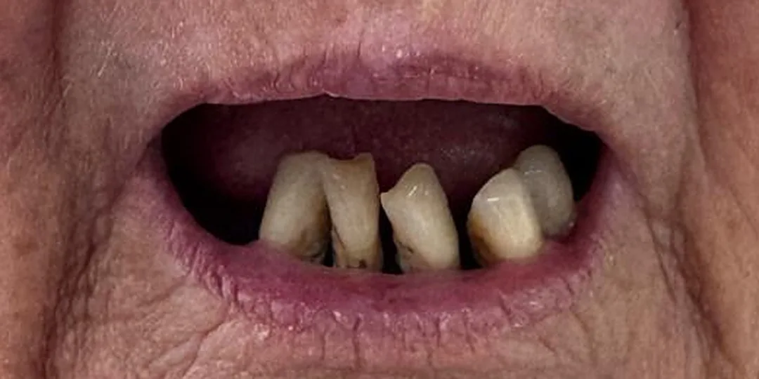 Before treatment, cropped to the mouth: the patient’s own remaining teeth.