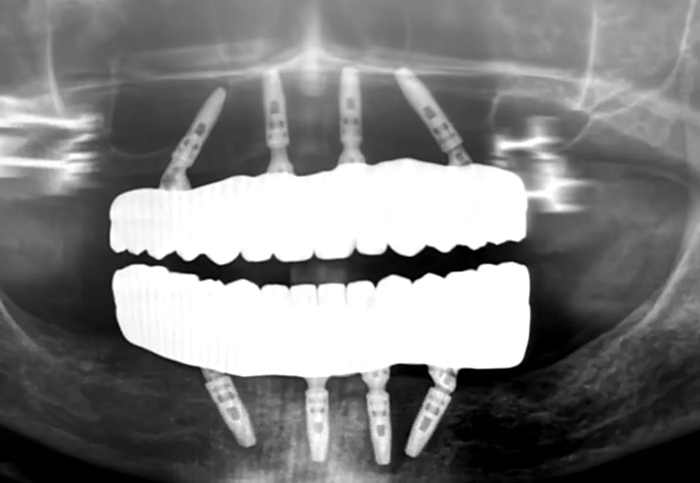 X-ray of both jaws: four implants in each, the back ones tilted, supporting the final bridges.