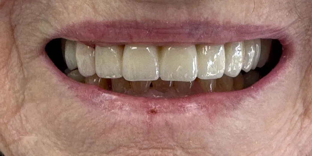 After: Full upper bridge