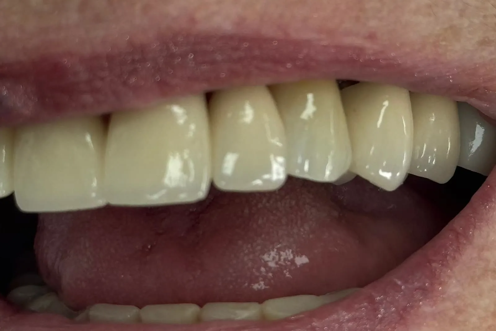 Clinical photograph after treatment: the arch complete, with the new crown in the place of the broken tooth.