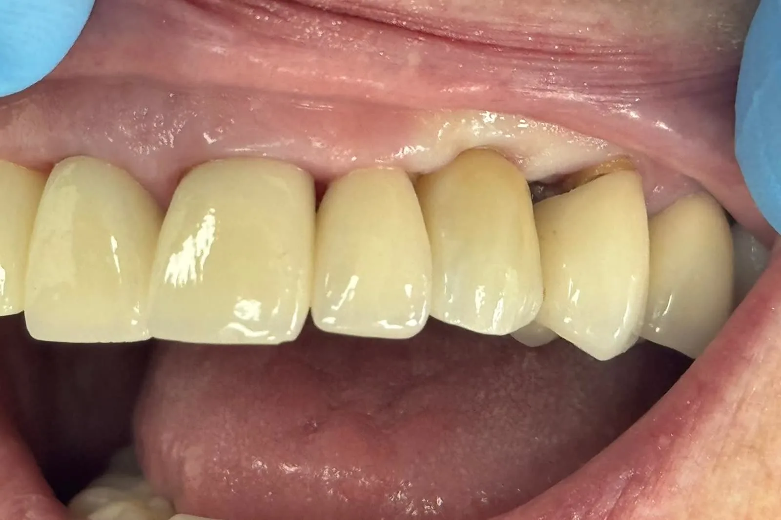 Clinical photograph before treatment: the upper left canine broken off level with the gum, with the teeth either side of it intact.