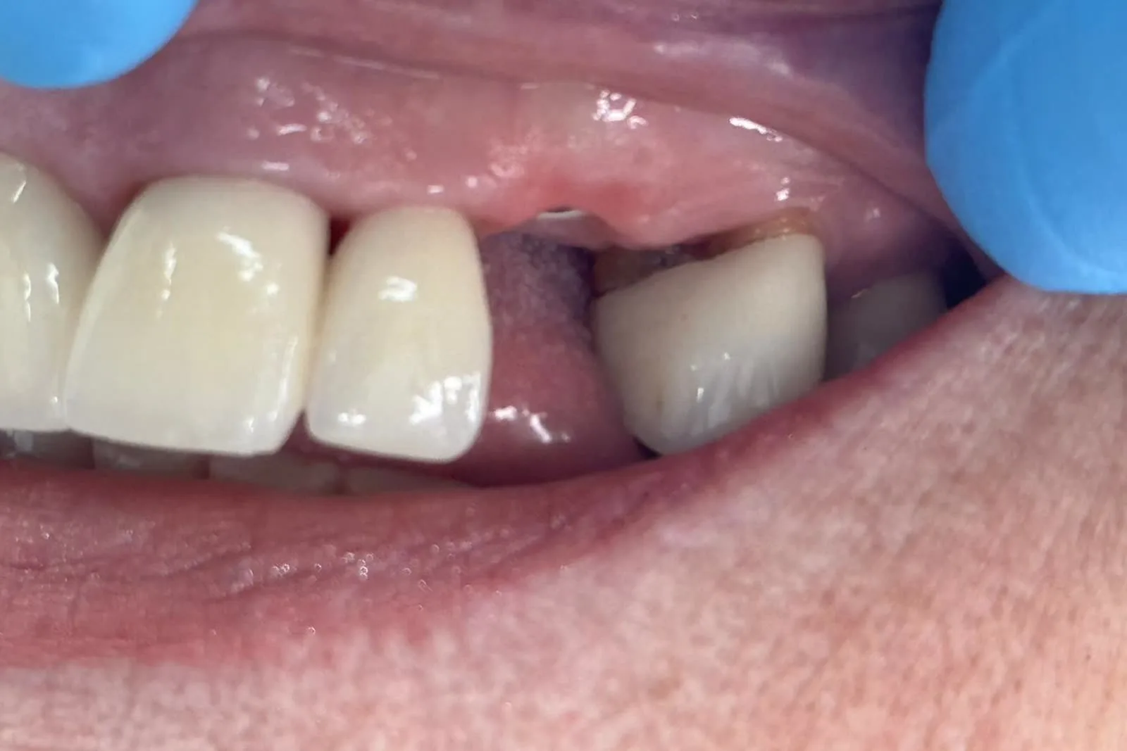 Clinical photograph after the broken root was removed, showing the space where the tooth had been.
