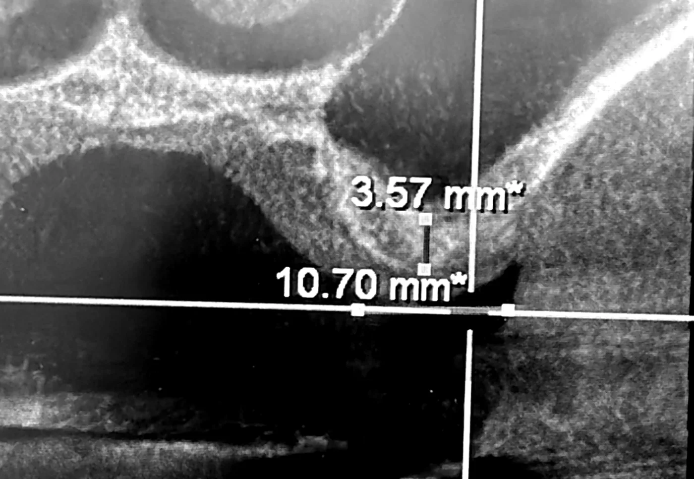 CT cross-section of the bone in the area, with Dr Brad’s own measurements on it: 10.70 mm across and 3.57 mm high.
