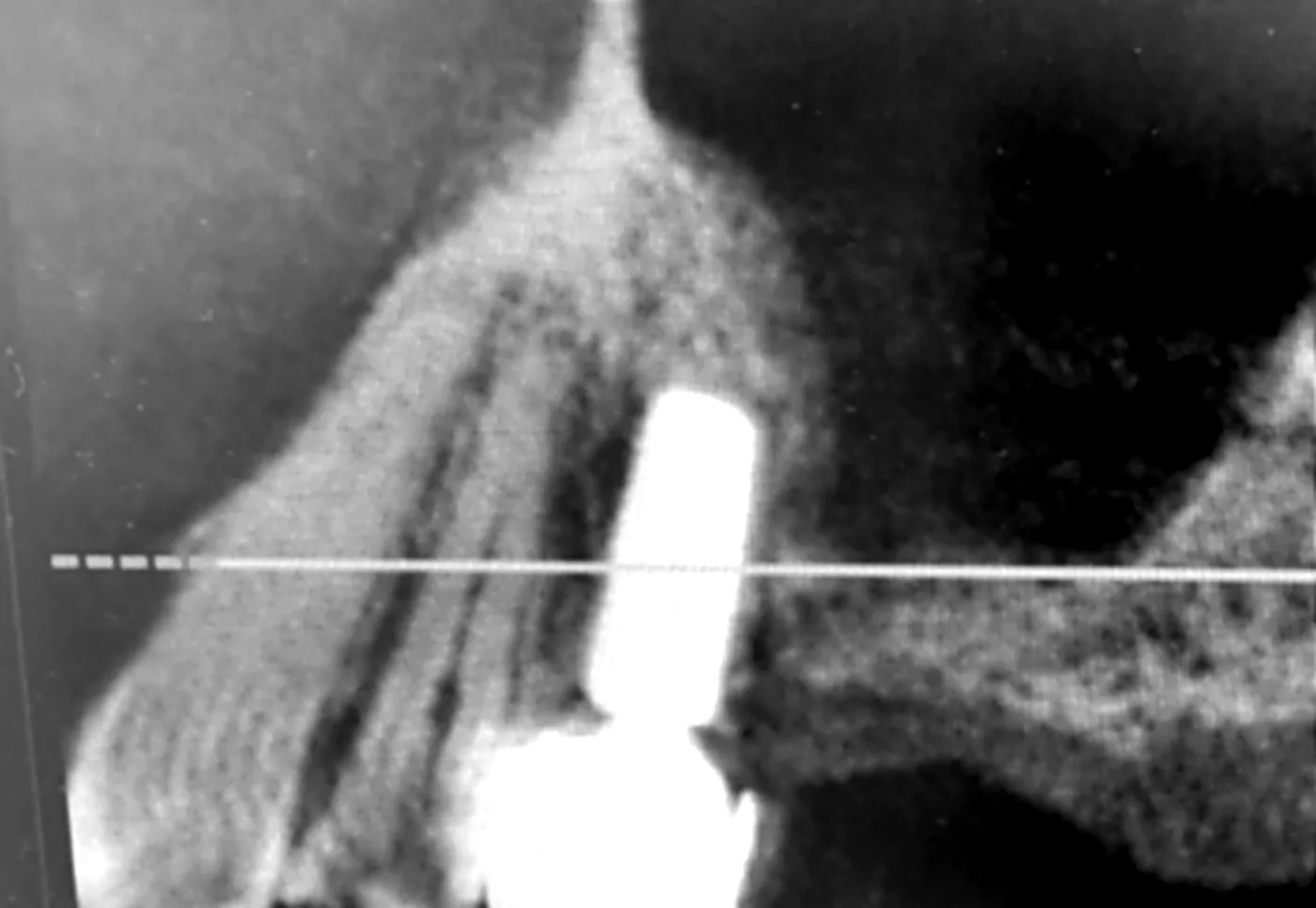 CT scan before treatment: a slice through the upper jaw in the area where the tooth was taken out.