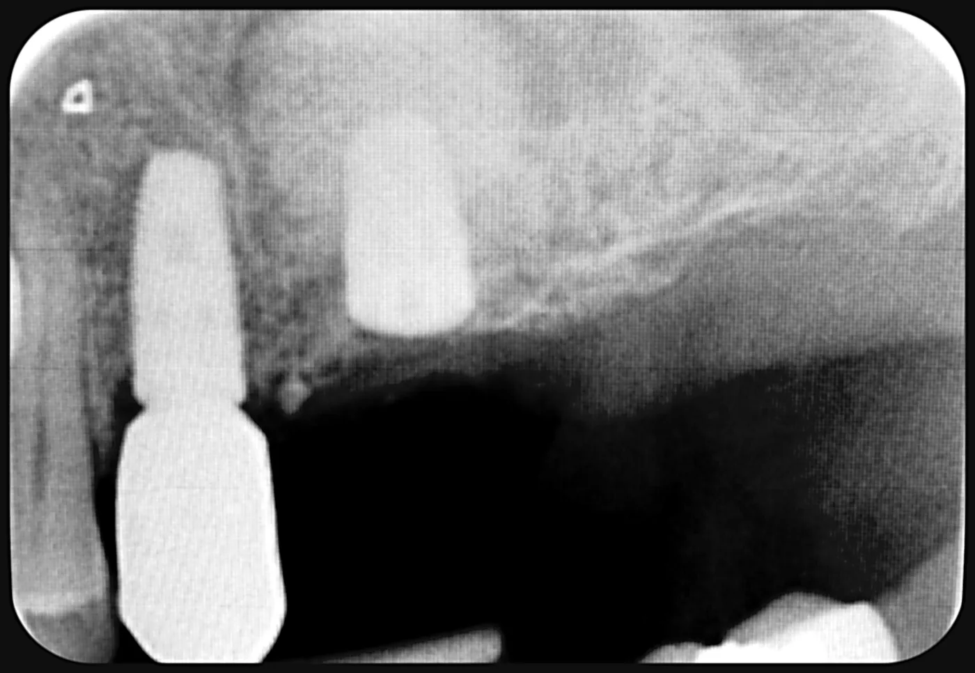 X-ray just after surgery: the implant in place, with the new bone graft material above it, outlined.