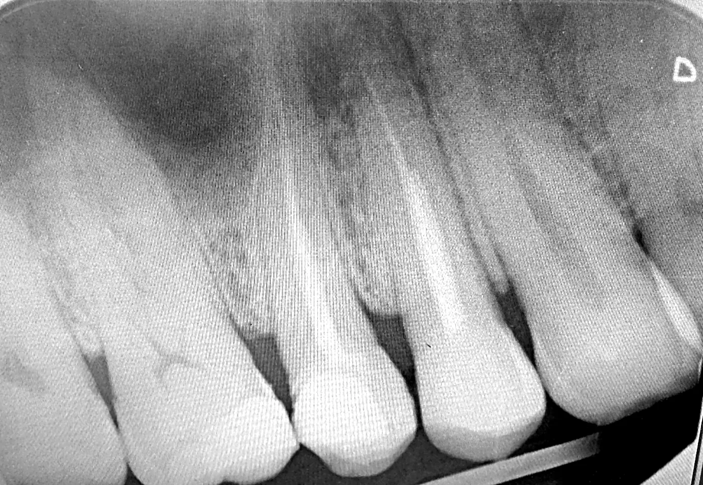 X-ray before treatment: two root-filled teeth, the one on the left broken off, with the sinus outlined above them.
