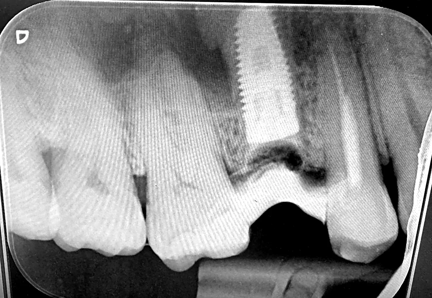 X-ray after extraction and immediate implant, with the bone graft outlined at the top of the implant.