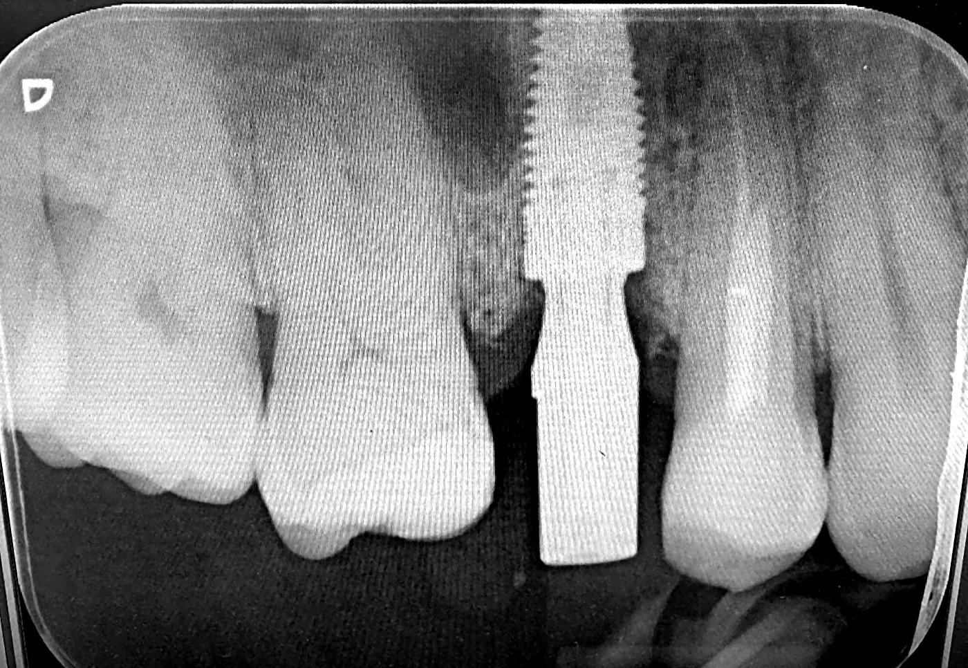 X-ray with a scan body seated on the implant, ready for the 3D digital scan.