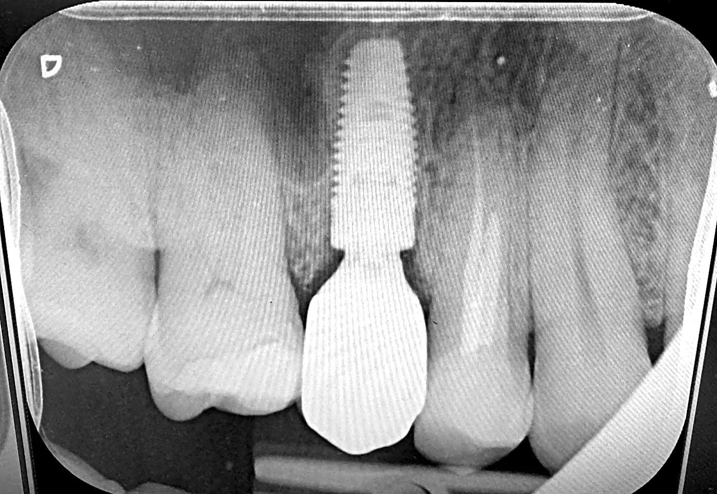 X-ray of the finished result: the single crown screwed onto the implant.